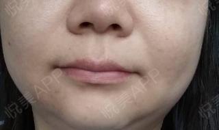 做去眼袋手术多少钱